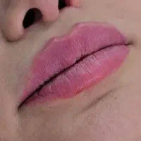 فیلرگونه لب/مزو/آنزیم/ پی آر پی/پی آر اف بوتاکس