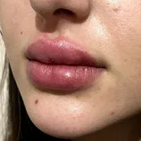 ژل/فیلر/بایوفیلر/پلاسماژل/ جایگزین فیلر|آرایشی، بهداشتی، درمانی|شیراز, آزادگان|دیوار
