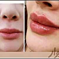 نیازمند مدل بوتاکس و ژل.اموزش ژل و بوتاکس|خدمات آرایشگری و زیبایی|صدرا-فارس, فاز ۱|دیوار