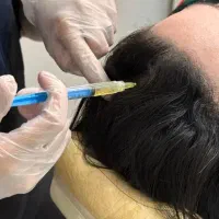 تزریق پی‌ارپی،هیرفیلر،مزوتراپی،کاشت مو،کاشت ابرو