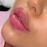 تزریق ژل و بوتاکس