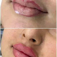 تزریق ژل وبوتاکس برای مدل|خدمات آرایشگری و زیبایی|اهواز, پردیس دو|دیوار