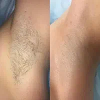 پک موبر دائمی آکنرا|آرایشی، بهداشتی، درمانی|تهران, چیتگر جنوبی|دیوار