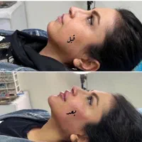 بوتاکس لیبل دار واحدی ۲۰۰ ژل اورجینال توسط پزشک|خدمات آرایشگری و زیبایی|اصفهان, احمدآباد|دیوار