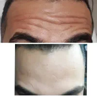 آف بوتاکس و فیلر پاکسازی پوست