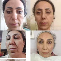 جشنواره اگزوزوم، فیلر بادی نخ،ژل،پی ارپی|خدمات آرایشگری و زیبایی|تهران, سعادت‌آباد|دیوار