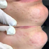 پاکسازی و جوانسازی پوست و صورت