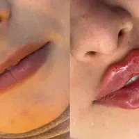 ژل و بوتاکس و مزو|خدمات آرایشگری و زیبایی|کرج, کیانمهر|دیوار