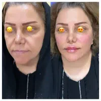 مدل ژل و بوتاکس جهت فیلمبرداری تبلیغات