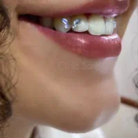 انجام پیرسینگ و نگین دندان در مطب زیرنظر پزشک