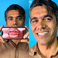 ایمپلنت دیجیتال