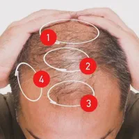 رفع ریزش مو، چربی کف سر، طاسی کامل و رویش مجدد