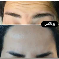 جشنواره تخفیف ژل لبروسی،فیلرشقیقه،بوتاکس توسط پزشک|خدمات آرایشگری و زیبایی|کرج, گلشهر|دیوار
