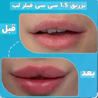 50٪تخفیف خدمات فیلر بوتاکس مزوتراپی پرسینگ چال لپ|خدمات آرایشگری و زیبایی|اصفهان, مولوی|دیوار