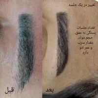 دستگاه کربن تراپی روشن کننده و از بین برنده تاتو|پزشکی|کرج, گلشهر|دیوار
