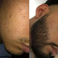 رویش تار جدید ریشات