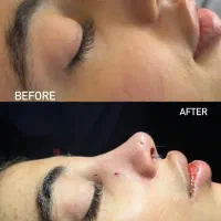 آف ویژه زیبایی بینی|خدمات آرایشگری و زیبایی|بهبهان, |دیوار