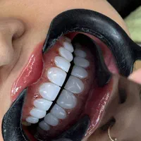 جشنواره کامپوزیت دندان با بهترین متریال آمریکایی|خدمات آرایشگری و زیبایی|آمل, |دیوار