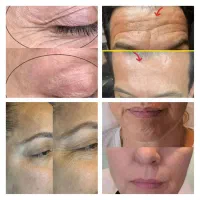 درمان لک کک مک تیرگی منافذ باز جوش چین و چروک