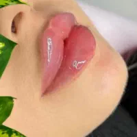 مدل ژل و بوتاکس