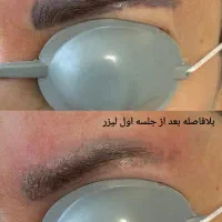 پاک کردن تتو با لیزر کیوسوییچ تضمینی