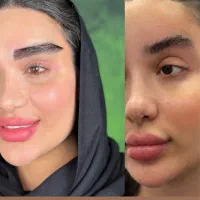 کاشت ابرو طبیعی fit+ برای اولین بار در مازندران