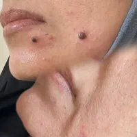 خالبرداری ،مزو ،پی ار پی کلینیک فقط ۹۰۰