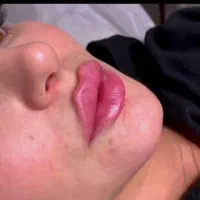 جشنواره تابستانه تزریق ژل و بوتاکس