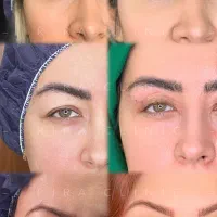 زیبایی با فوق تخصص بلفارو،لیفت ابرو،بوکال،لیپوابدو