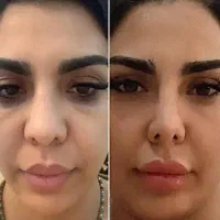 پلاسما کوچیک کردن بینی از بین بردن جای زخم