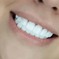 کامپوزیت زیبایی دندان پزشکی|خدمات آرایشگری و زیبایی|یاسوج, |دیوار