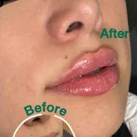 فیلر لب روسی