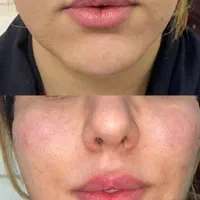 تخفیفات خدمات فیلر و بوتاکس کلینیک|خدمات آرایشگری و زیبایی|شاهین‌شهر, فردوسی|دیوار