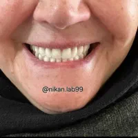 دندانسازی دندان مصنوعی تحویل ۲روزه باضمانت|خدمات آرایشگری و زیبایی|اصفهان, کشاورزی|دیوار