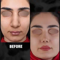 جراحی بینی ابدو‌ساکشن بلفارو(پلک) تیپ پلاستی کاشت|خدمات آرایشگری و زیبایی|مشهد, سجاد شهر|دیوار