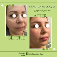 تزریق فیلر زیر چشم|خدمات آرایشگری و زیبایی|تهران, جردن|دیوار