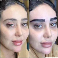 کاشت تخصصی مو و ابرو
