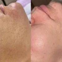 پاکسازی پوست، فیشال و ماسک تخصصی