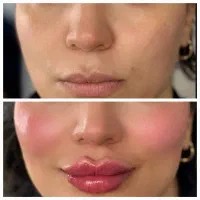 آف ویژه آموزش ژل وبوتاکس وتتوصورت وبدن