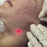 اندولیفت،جوانسازی و لیفت پوست روش غیرجراحی