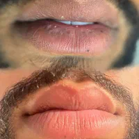 رفع تیرگی دائمی لب (فقط آقایان)|خدمات آرایشگری و زیبایی|اهواز, سپیدار|دیوار