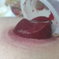 حجامت بادکش.طب سنتی برداشت خال وبا پزشک