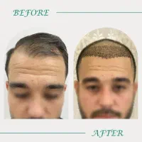 کاشت مو پرتراکم