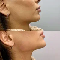 آموزش وخدمات تزریق ژل چربی بلفارنخ ساکشن غبغب لیزر|خدمات آرایشگری و زیبایی|اسلام‌شهر, باغ فیض|دیوار