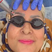 پاک کردن تتو با لیزر (ارزانترین قیمت بهترین کیفیت)