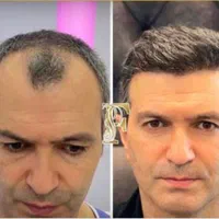 کاشت مو ابرو ریش بدون جراحی ضمانتنامه مادام العمر|خدمات آرایشگری و زیبایی|تهران, الهیه|دیوار