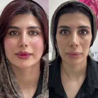 تزریق تخصصی ژل وبوتاکس،چربی،هایفو،نخ،توسط پزشک|خدمات آرایشگری و زیبایی|کرمانشاه, |دیوار