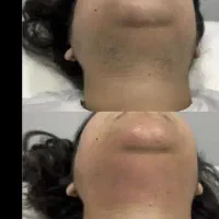 دستگاه لاغری حجم دهی وفرم دهی لیزر