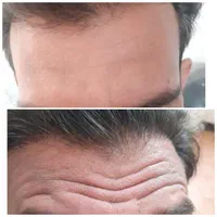 لیزر بوتاکس ژل خالبرداری|خدمات آرایشگری و زیبایی|سیرجان, |دیوار