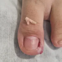 درمان آسیب های ناخن بدون درد و جراحی